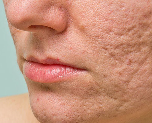 mụn trứng cá để lại sẹo - Image 3