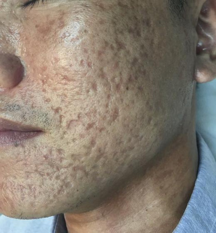 mụn trứng cá để lại sẹo