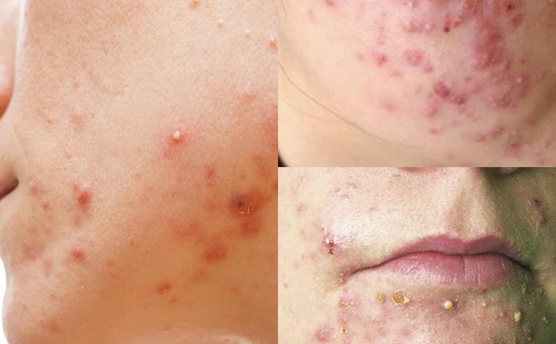 mụn trứng cá do mỹ phẩm - Image 2
