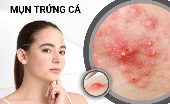 mụn trứng cá do mỹ phẩm - Image 3