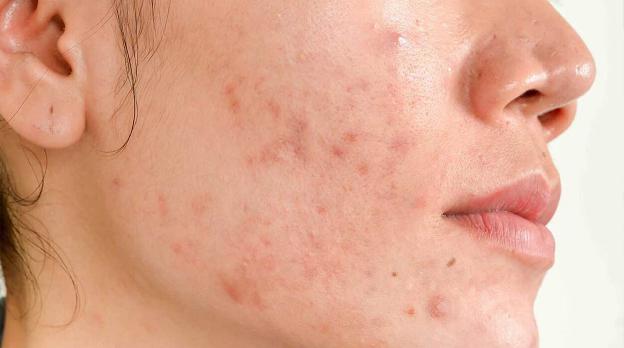 mụn trứng cá do nội tiết