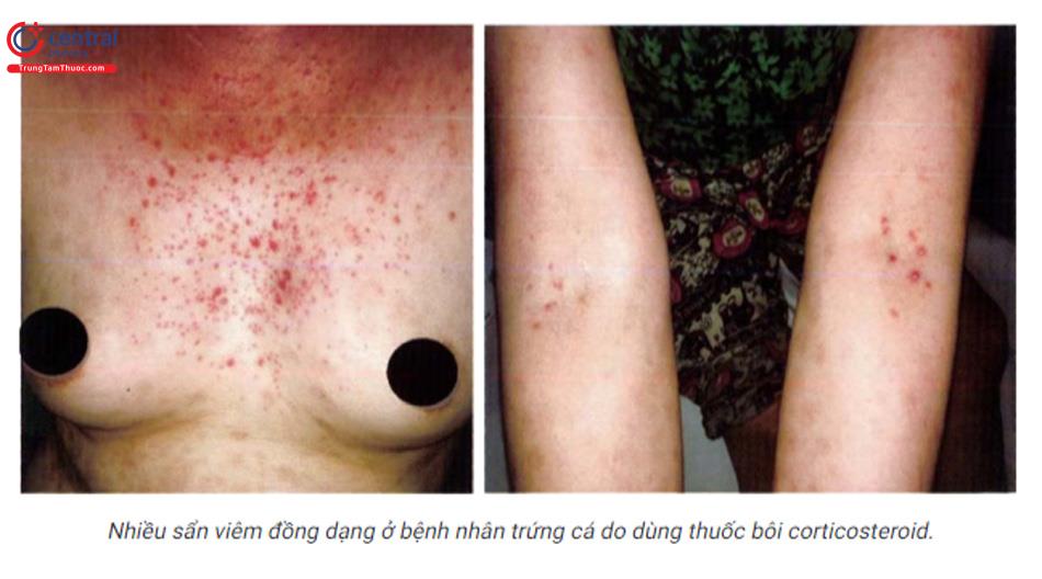 mụn trứng cá do thuốc - Image 2
