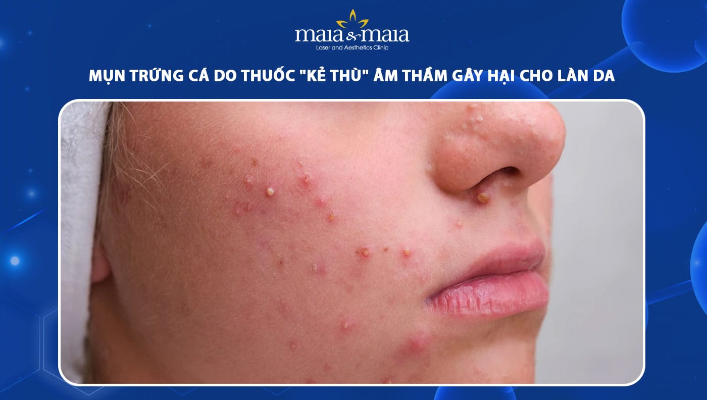 mụn trứng cá do thuốc - Image 3