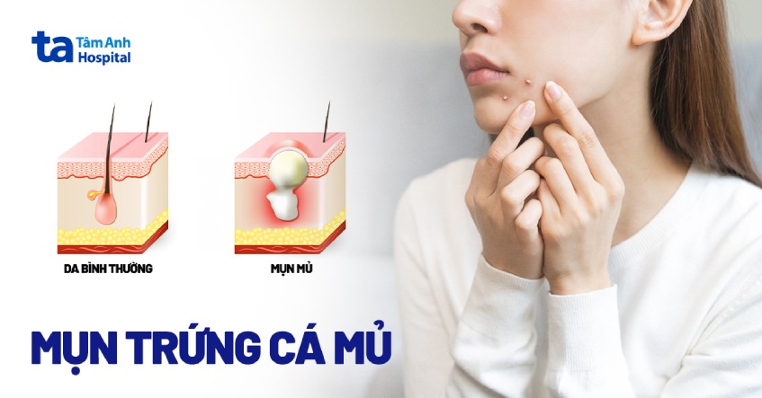 mụn trứng cá mủ - Image 2
