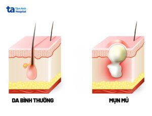 mụn trứng cá mủ