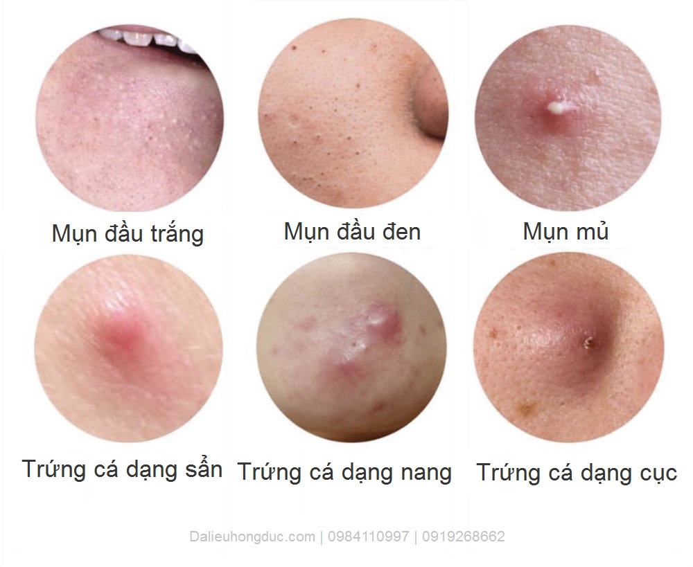 mụn trứng cá mủ - Image 5