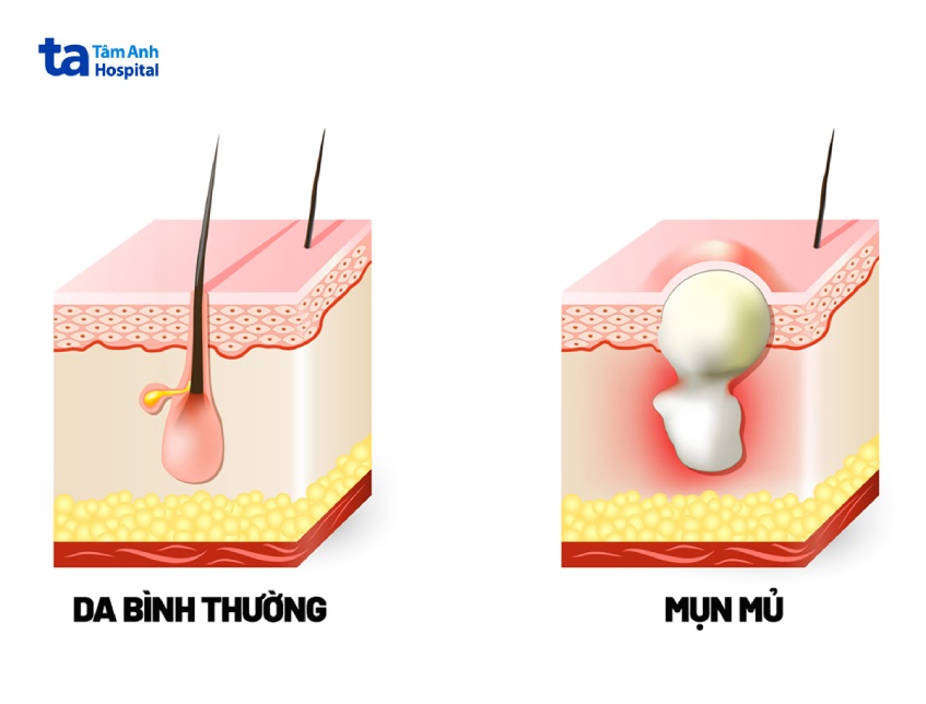 mụn trứng cá mủ