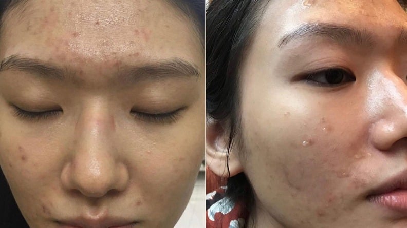 mụn trứng cá nội tiết - Image 3