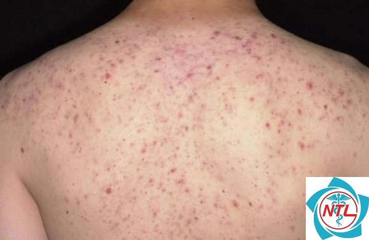 mụn trứng cá ở lưng