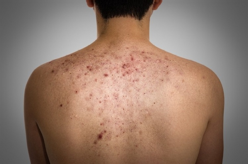 mụn trứng cá ở nam giới - Image 2