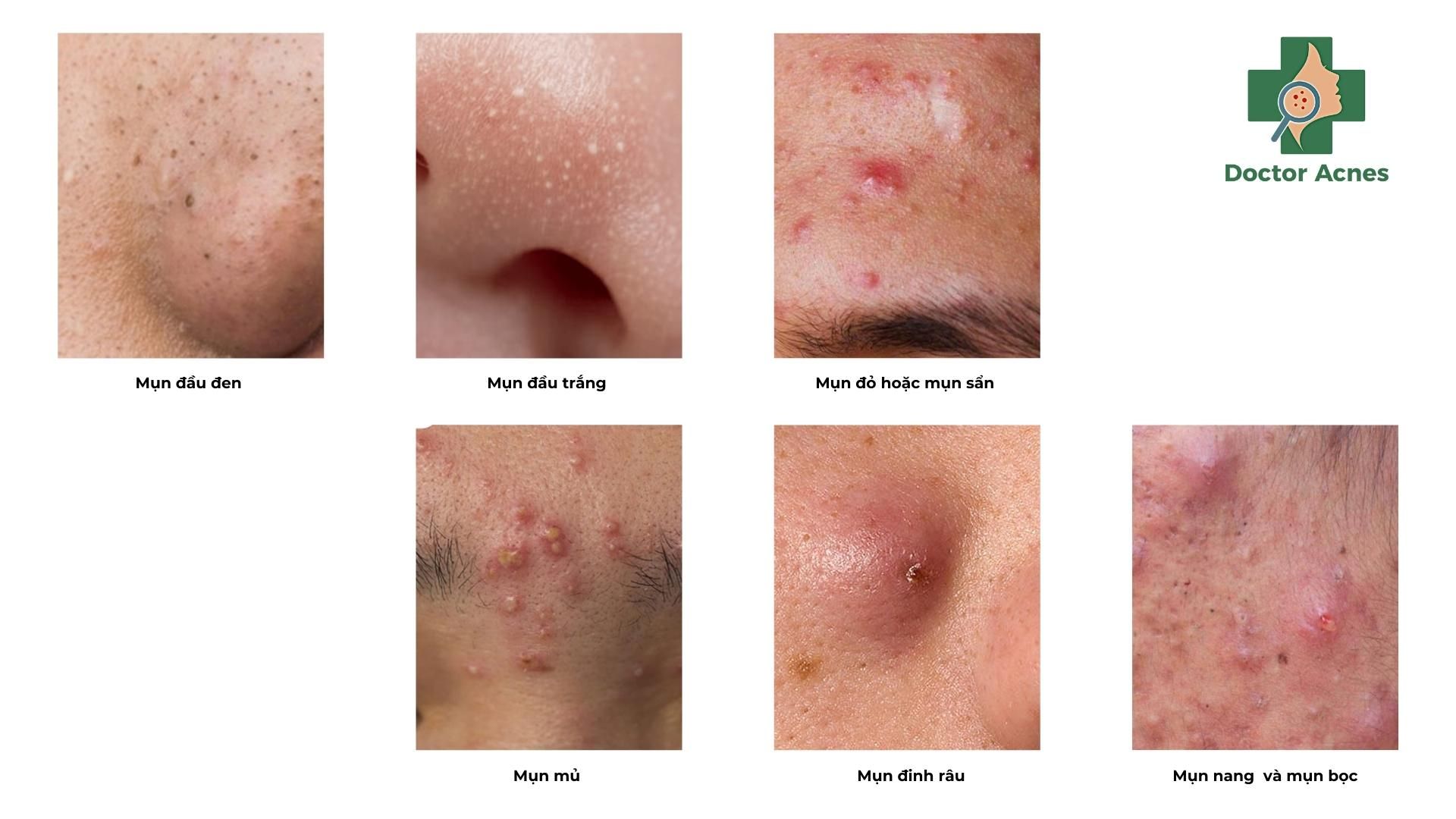 mụn trứng cá ở nam giới - Image 3