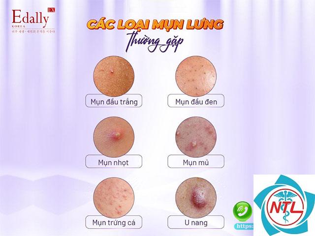 mụn trứng cá ở ngực - Image 2