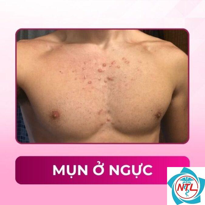 mụn trứng cá ở ngực - Image 5
