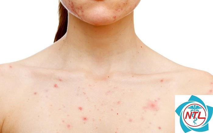 mụn trứng cá ở ngực
