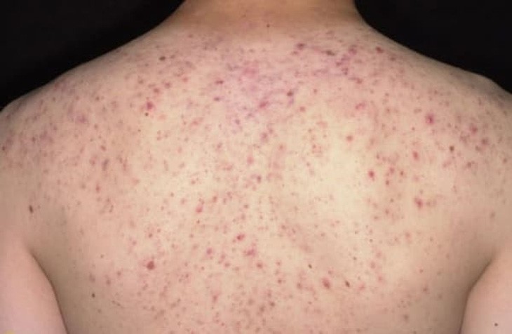 mụn trứng cá ở người lớn - Image 3