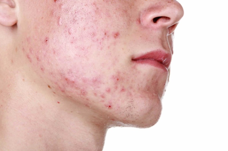 mụn trứng cá ở người lớn - Image 5