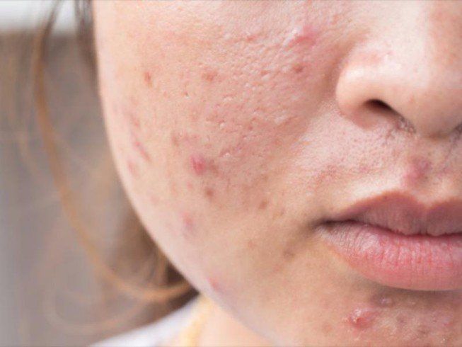 mụn trứng cá ở người lớn