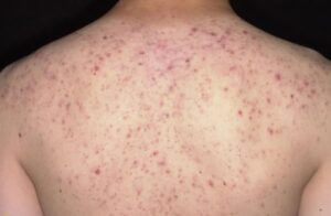 mụn trứng cá ở phụ nữ
