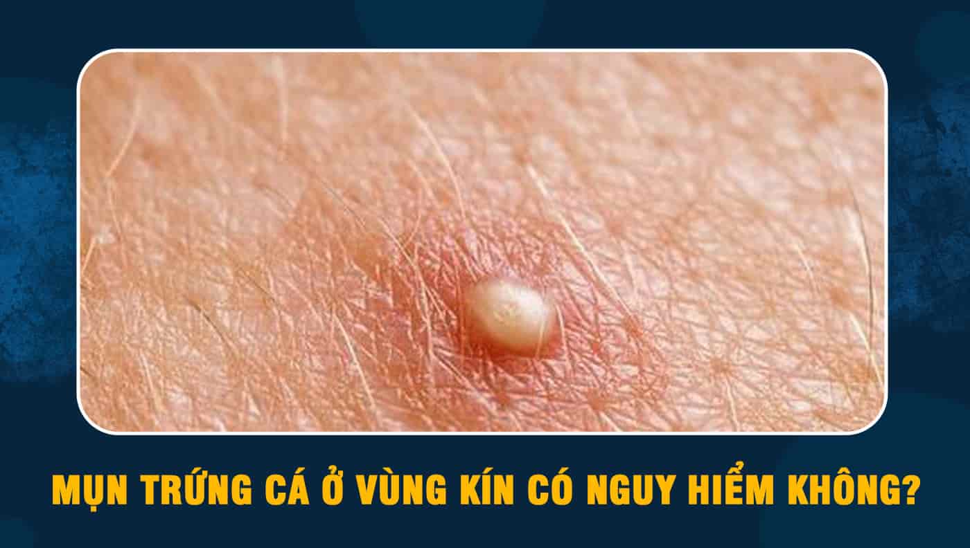 mụn trứng cá ở phụ nữ - Image 4