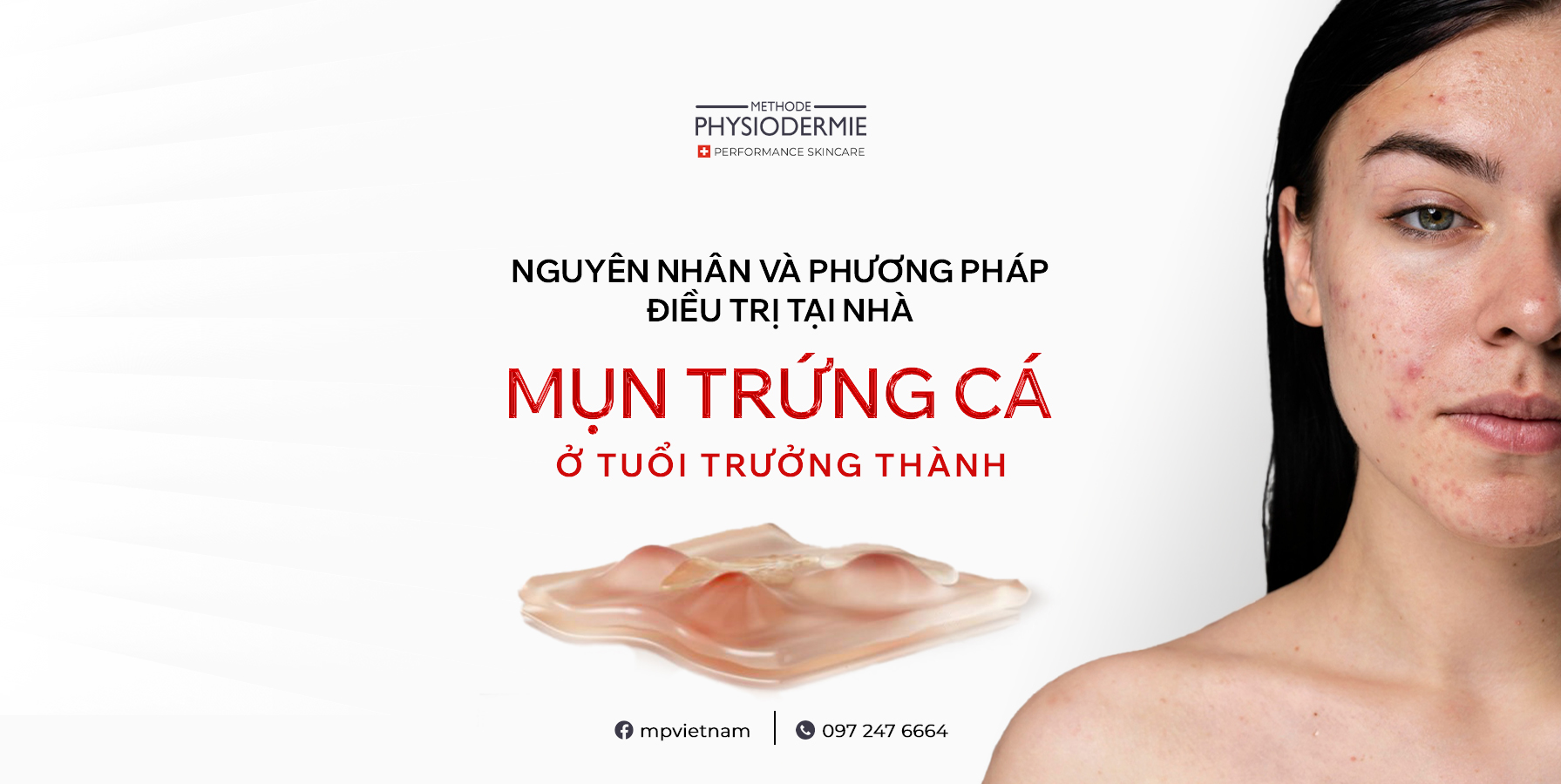 mụn trứng cá ở tuổi trưởng thành - Image 3
