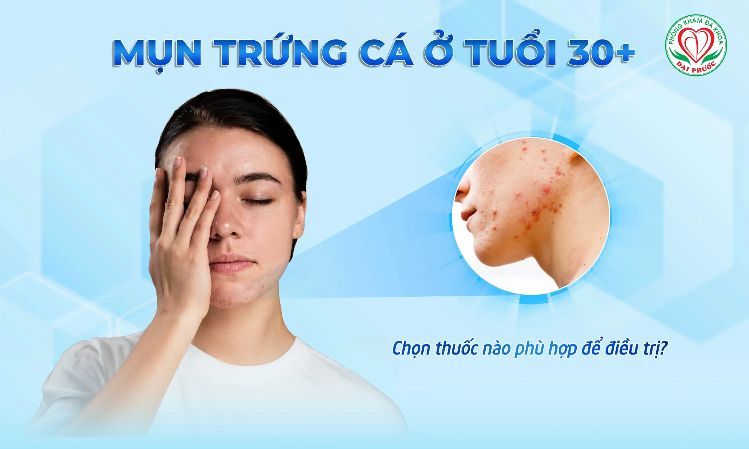 mụn trứng cá ở tuổi trưởng thành - Image 5