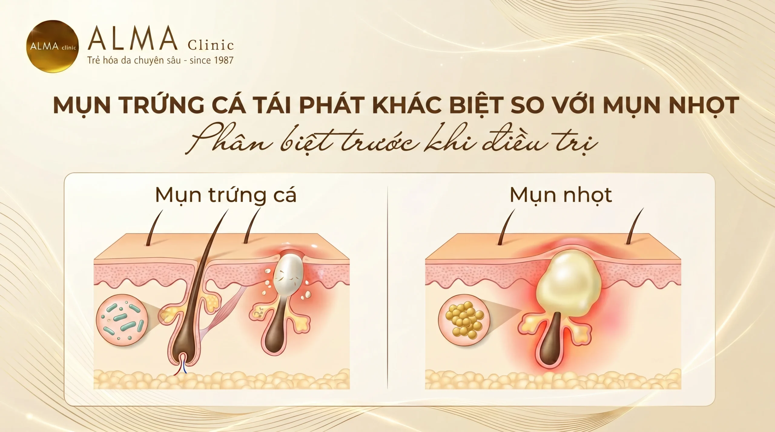 mụn trứng cá tái phát - Image 2