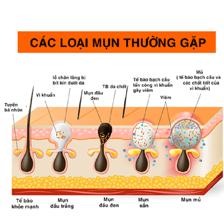 mụn trứng cá tái phát - Image 3