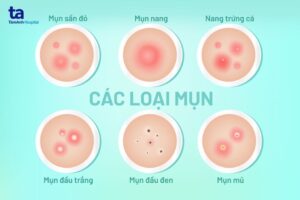 mụn trứng cá tuổi dậy thì