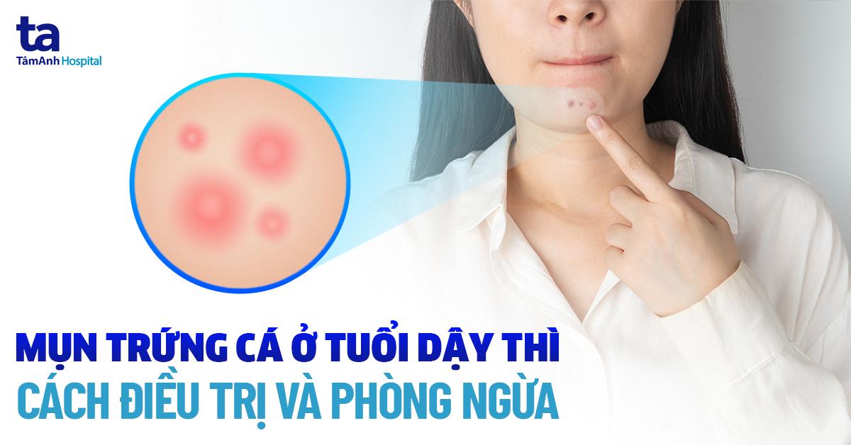 mụn trứng cá tuổi dậy thì - Image 3