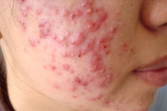 mụn trứng cá tuổi dậy thì - Image 4