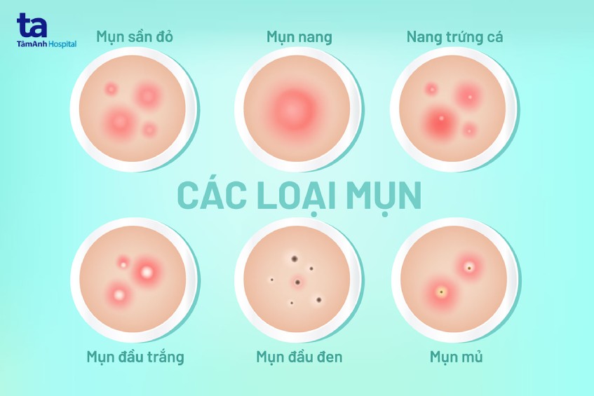 mụn trứng cá tuổi dậy thì