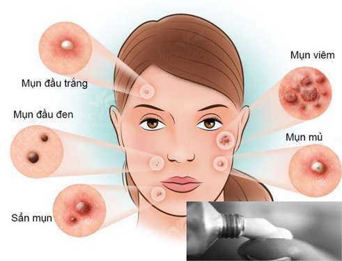 mụn trứng cá viêm - Image 3
