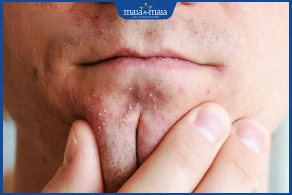 mụn trứng cá vùng cằm - Image 3