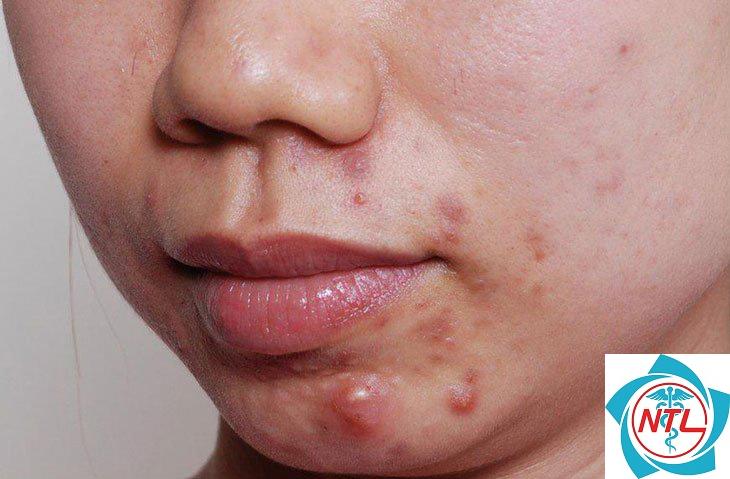 mụn trứng cá vùng cằm - Image 5