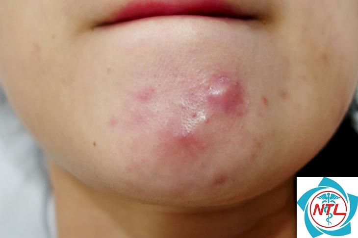 mụn trứng cá vùng cằm