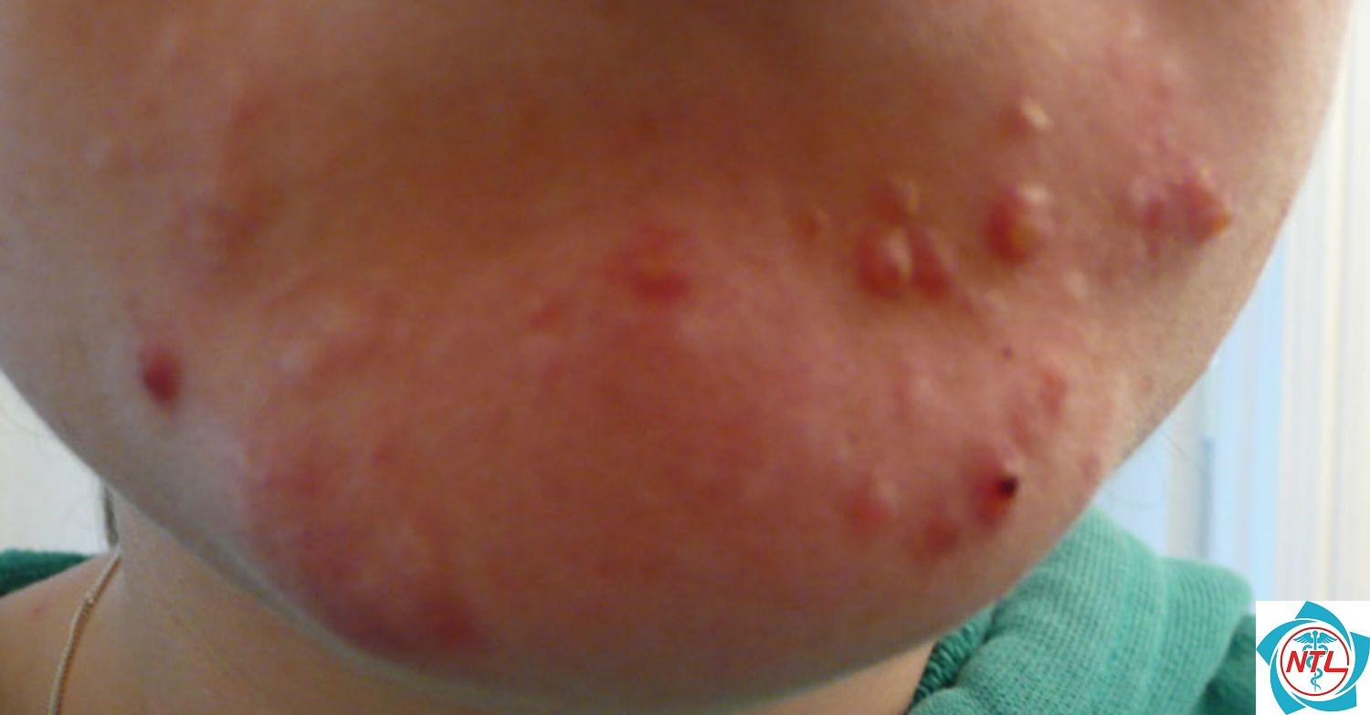 mụn trứng cá vùng hàm - Image 3