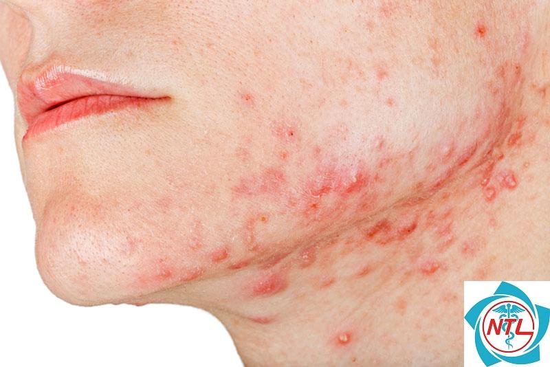 mụn trứng cá vùng hàm
