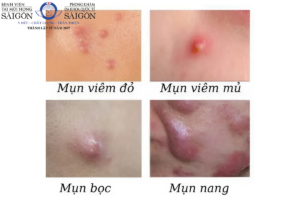 mụn viêm