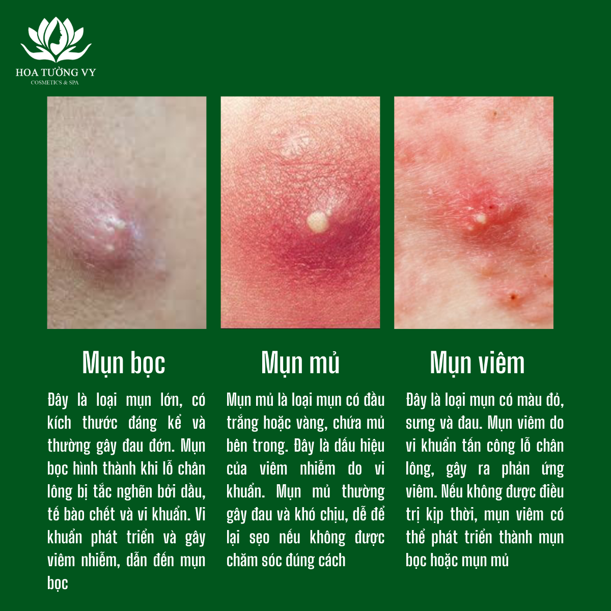 mụn viêm - Image 4