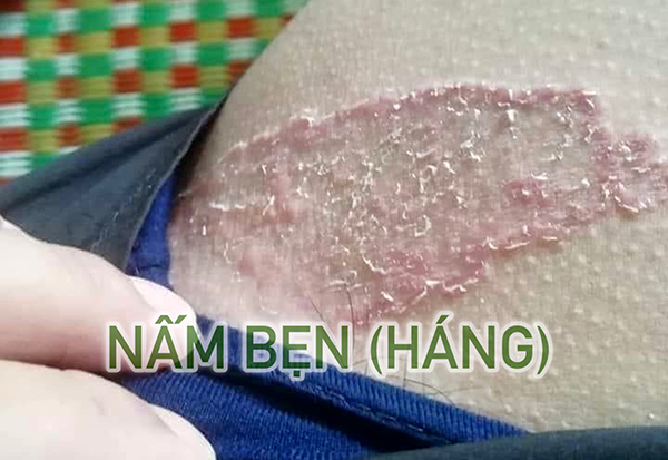 nấm bẹn - Image 4
