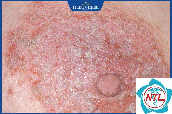 nấm candida dưới vú - Image 3