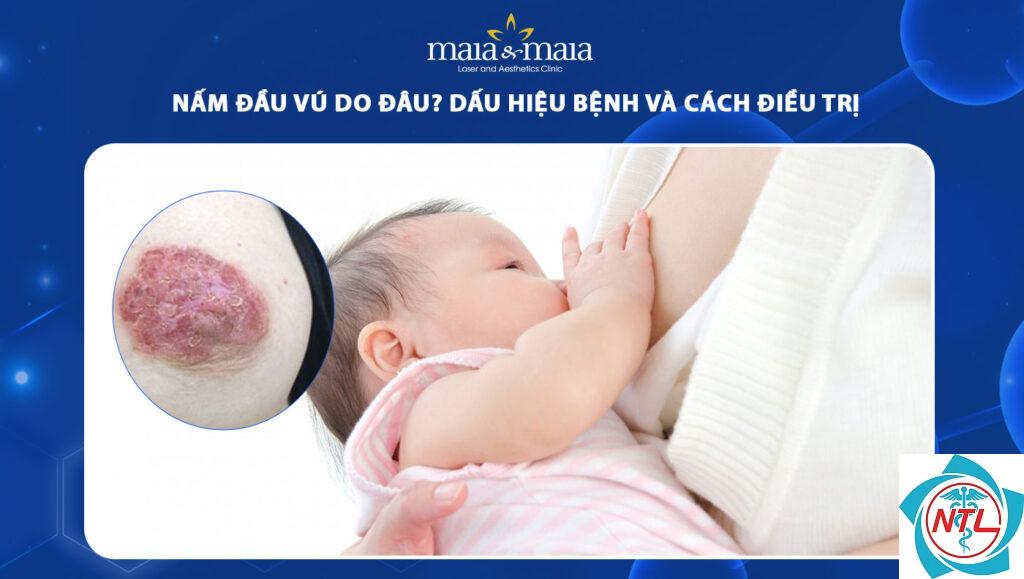 nấm candida dưới vú - Image 5