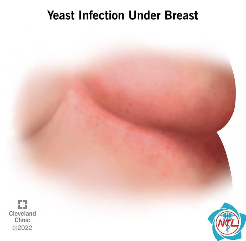 nấm candida dưới vú