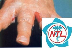 nấm candida ngoài da - Image 5
