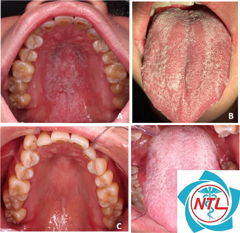 nấm candida ở người lớn - Image 3