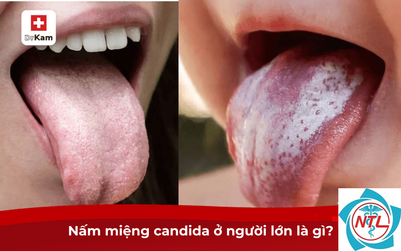 nấm candida ở người lớn - Image 4