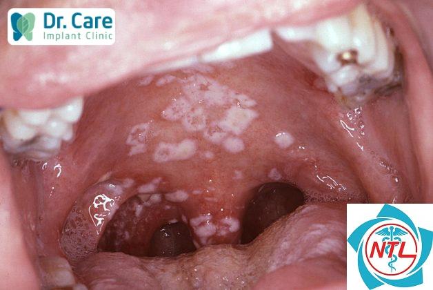 nấm candida ở người lớn