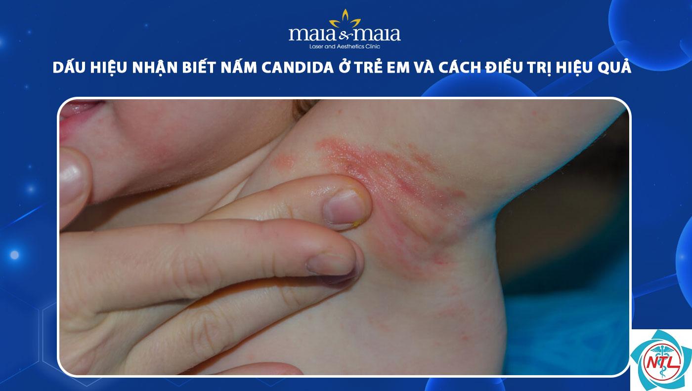nấm candida ở trẻ em - Image 2