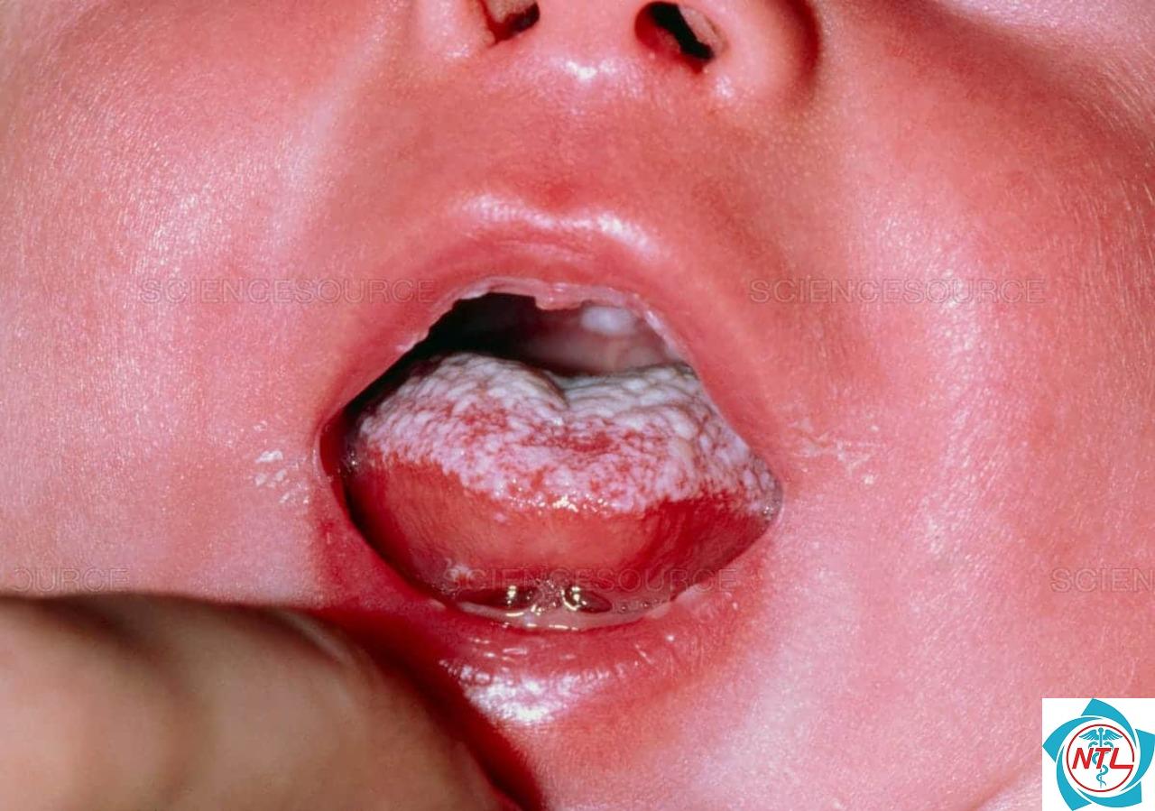 nấm candida ở trẻ em - Image 3