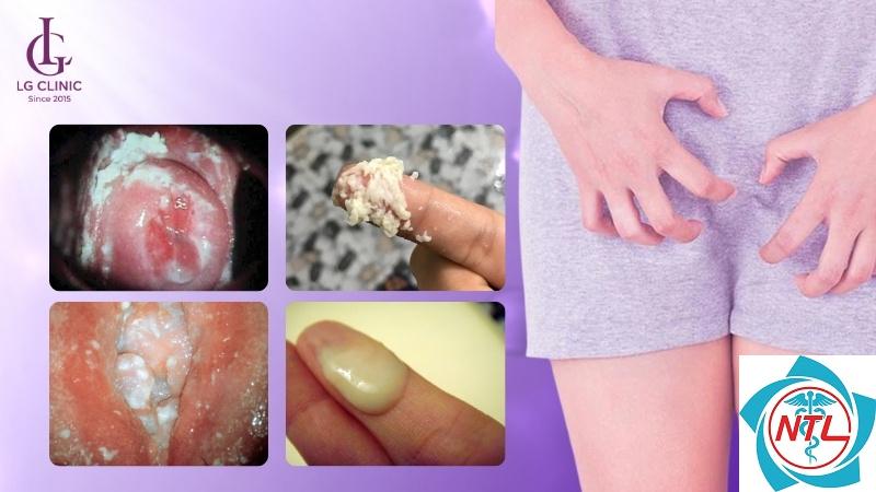 nấm candida vùng bẹn - Image 2